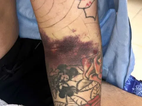 Suýt mất cánh tay vì biến chứng nguy hiểm sau khi bị muỗi đốt