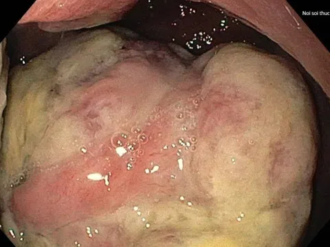 Hai triệu chứng lạ giúp người đàn ông phát hiện mắc ung thư