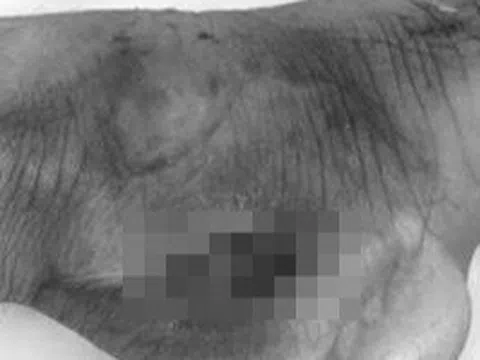 Tuyên Quang ghi nhận nhiều ca mắc bệnh 'vi khuẩn ăn thịt người' sau lũ