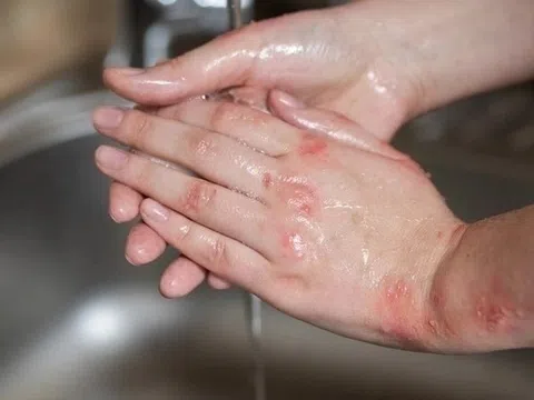 Sinh vật siêu nhỏ gây nên căn bệnh ngứa dữ dội ban đêm