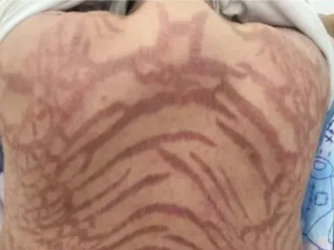 Người phụ nữ có làn da rắn sau 10 năm bôi thuốc 'thuần Đông y'