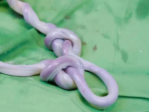 Bé trai chào đời với dây rốn thắt nút thành búi