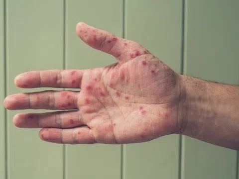 Loại virus đang lan 'vượt ngoài tầm kiểm soát’