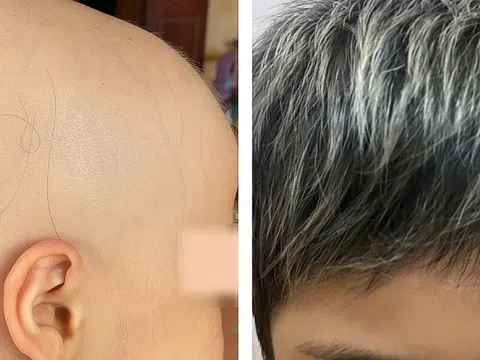 Bé gái 7 tuổi bị rụng hết tóc được điều trị thành công