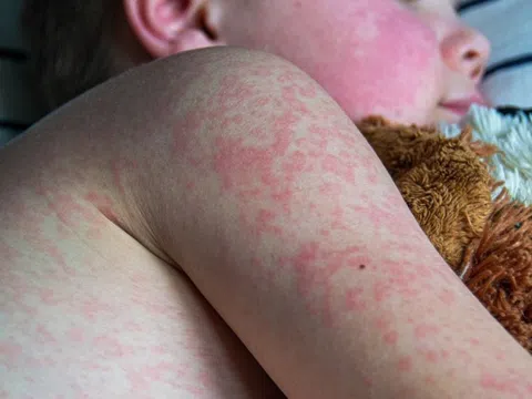 Cảnh giác với nguy cơ một dịch bệnh bùng phát trên toàn cầu