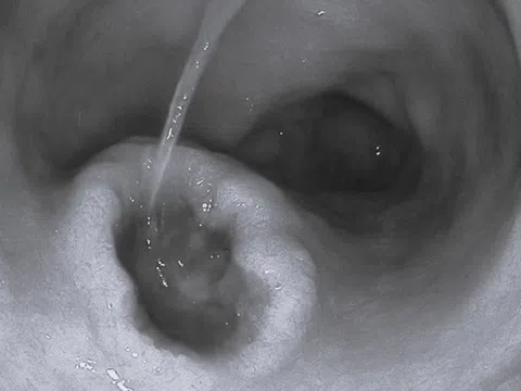 Dạ dày loét nặng vì thói quen phổ biến của người Việt khi đau