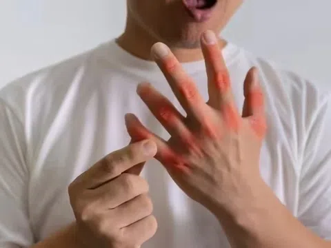 Dấu hiệu cảnh báo nồng độ axit uric tăng cao