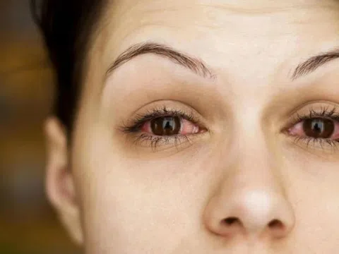 Triệu chứng của thận yếu biểu hiện ở mắt