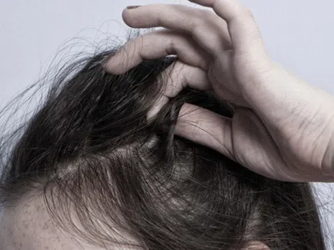 Thói quen thích nhổ tóc có thể là bệnh lý tâm thần?
