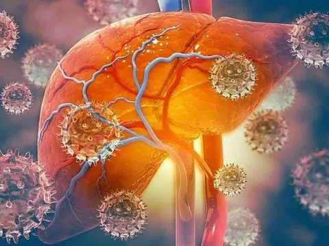 Những người cần đi khám gan sớm và thường xuyên