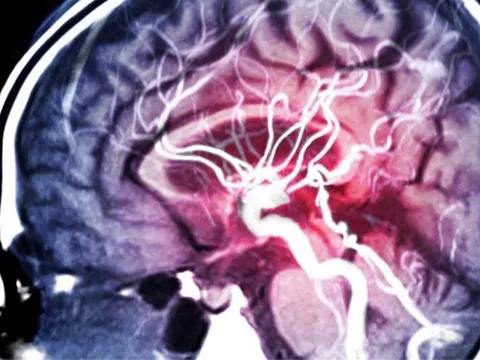Phát hiện gây sốc: Huyết áp chưa tăng nhưng não đã lão hóa