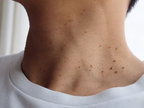 Tiểu đường tăng nhanh ở người trẻ, bác sĩ chỉ cách phòng bệnh