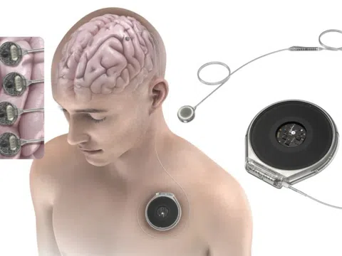 Đối thủ của Neuralink được thử nghiệm cấy chip vào não người