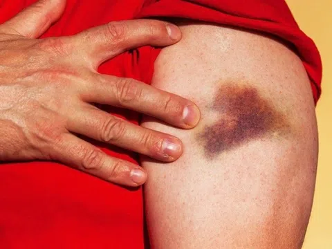 Dấu hiệu bệnh tiểu đường biểu hiện trên da