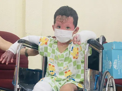 Tình hình bé trai bị bỏng 65% cơ thể trong vụ phóng hỏa ở Gia Lai