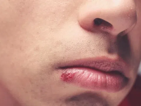 Người đàn ông mắc bệnh giang mai ở vị trí không ngờ