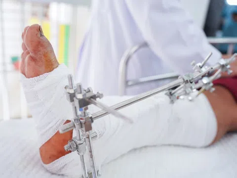 Người đàn ông nhập cấp cứu BV Chợ Rẫy với bàn chân đứt lìa