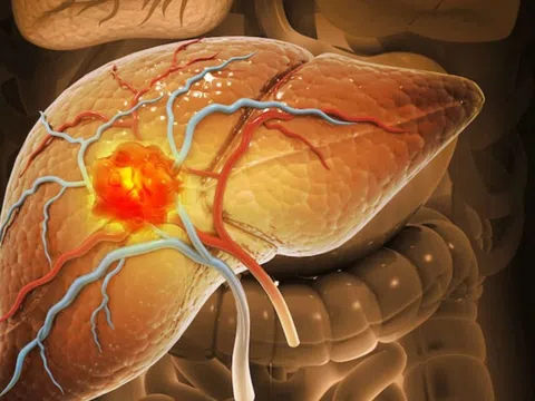 Ăn gì để giải độc gan và tăng cường chức năng gan?