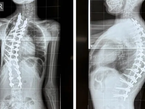 Bé gái mắc bệnh hiếm, bác sĩ BV Nhi đồng 1 lần đầu gặp