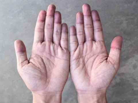 Triệu chứng của thận yếu biểu hiện ở da