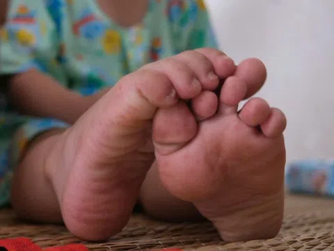 TP.HCM: Tác nhân EV71 tái xuất, ca mắc tay chân miệng nặng tăng