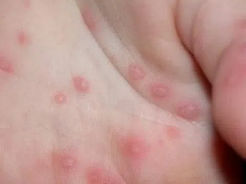 Bệnh tay chân miệng dùng thuốc như thế nào?