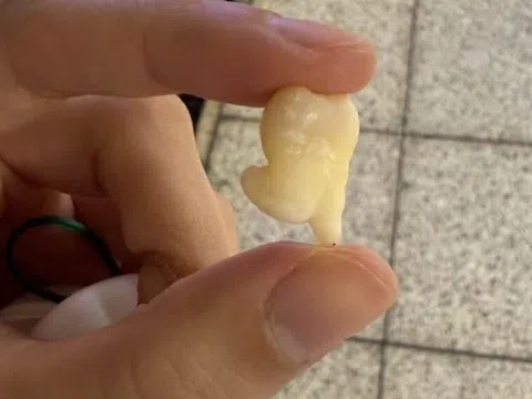 Răng khôn 'nhảy chân sáo' gây sốt MXH: Bác sĩ giải thích khi nào nhổ