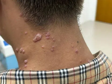 Đồng Nai phát hiện ca đậu mùa khỉ chưa rõ nguồn lây