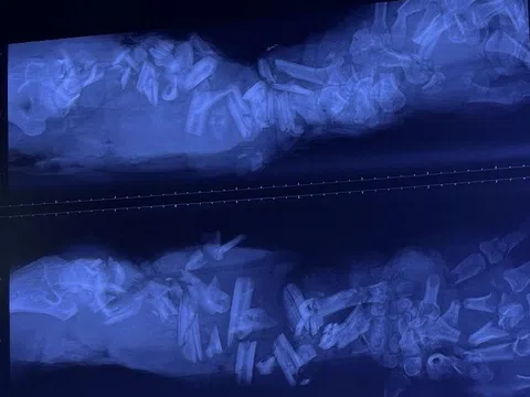 Người đàn ông nhập viện với cánh tay dập nát, xương gãy trăm mảnh