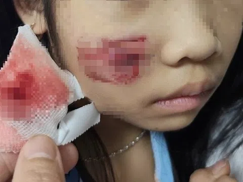 Cháu bé bị khỉ tấn công gây vết thương phức tạp vùng mặt, đầu