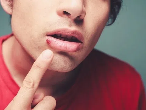 8 dấu hiệu bệnh gan biểu hiện ngay trên mặt