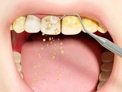 5 nguyên nhân gây hôi miệng