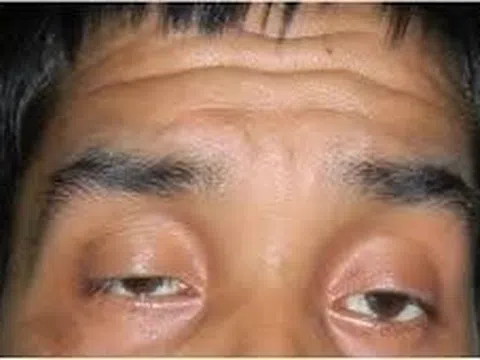 Bác sĩ Bệnh viện Nhân dân 115 điều trị ca bệnh rất hiếm gặp