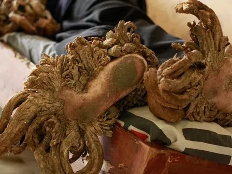 Bí ẩn kỳ lạ của căn bệnh 'người cây'