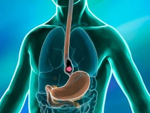 Chỉ trong buổi sáng, bệnh viện phát hiện 11 người mắc ung thư