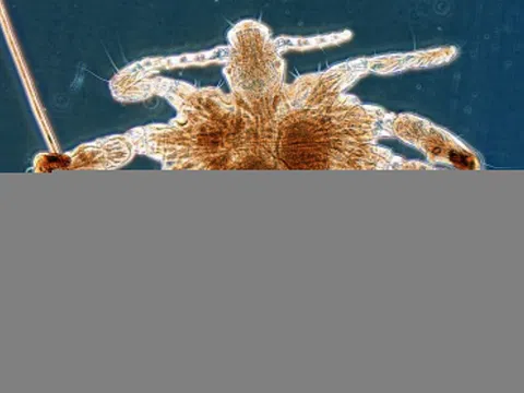 Ngứa vùng kín dữ dội, 'thủ phạm' nhỏ bé ít ai ngờ