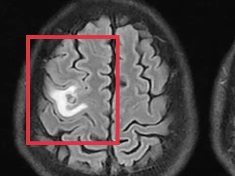 Món khoái khẩu khiến sán bám chi chít trong não người đàn ông