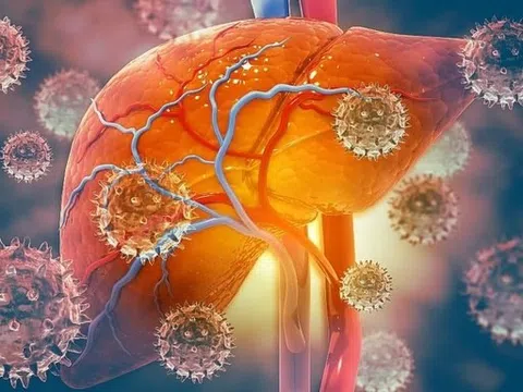 Nguyên nhân và các yếu tố nguy cơ ung thư gan