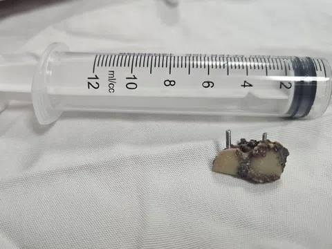 Bỗng dưng mất 2 chiếc răng, 20 năm sau bác sĩ phát hiện trong... phổi