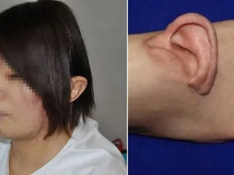 Ca phẫu thuật chưa từng có trên thế giới: Ghép tai bị đứt lên bàn chân rồi đưa về chỗ cũ