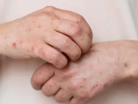 Dấu hiệu cảnh báo ung thư đại tràng xuất hiện trên da