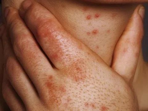 Tình dục mạo hiểm đẩy người trẻ Việt vào nguy cơ HIV, giang mai