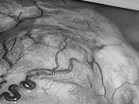 Một bệnh nhân cùng lúc phát hiện mắc 2 khối u ác tính