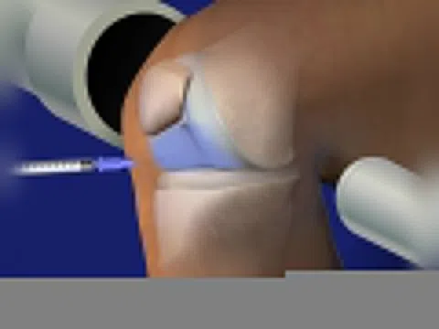 Xu hướng mới trong tiêm nội khớp điều trị bệnh xương khớp