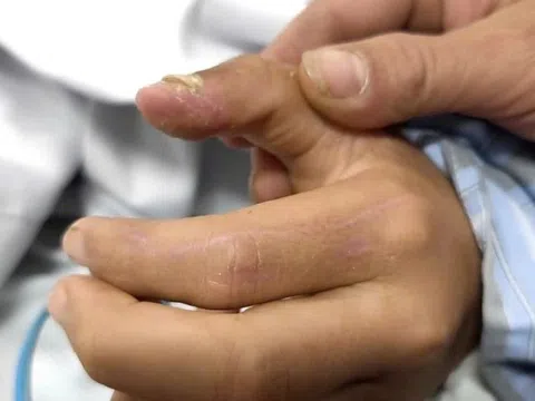 Vết chó cắn đã lành, bé trai 14 tuổi vẫn mắc bệnh dại