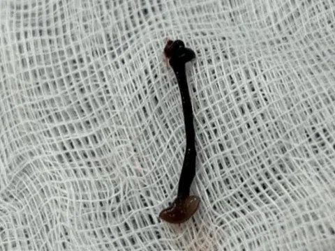 Bé trai chảy máu mũi cả tuần vì con vắt sống ký sinh trong hốc mũi