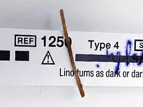 Nuốt que xiên nhỏ gây hậu quả lớn