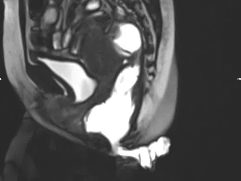 Gánh hậu quả nặng nề, chịu đau đớn vì chữa trĩ sai lầm