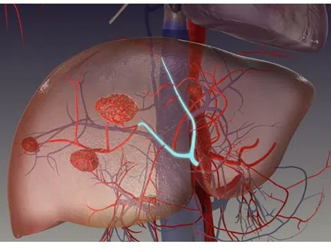 Đau tức hạ sườn, ăn kém, sút cân… là dấu hiệu bệnh gì?