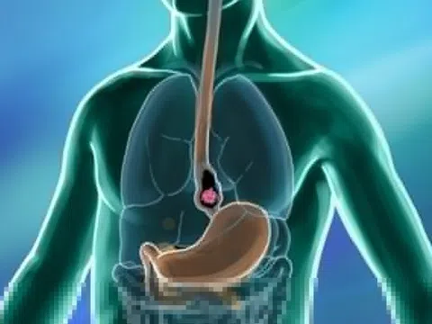 4 dấu hiệu sớm cảnh báo ung thư thực quản